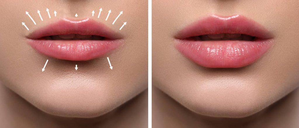 are lip fillers right for you