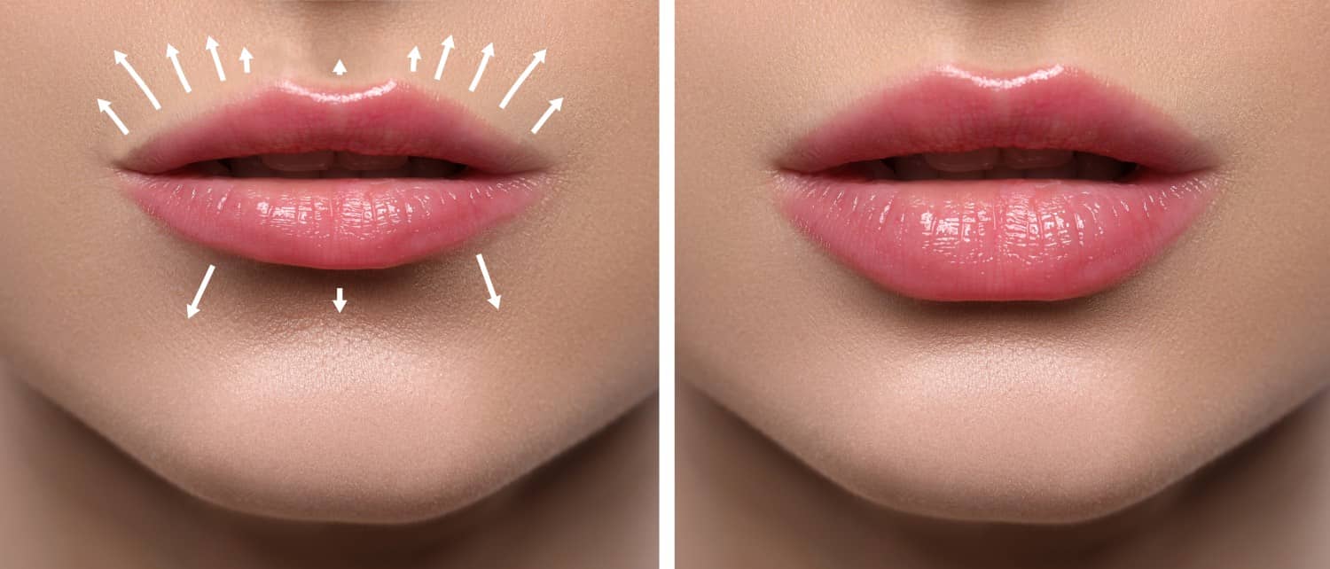 Are Lip Fillers Right for You?