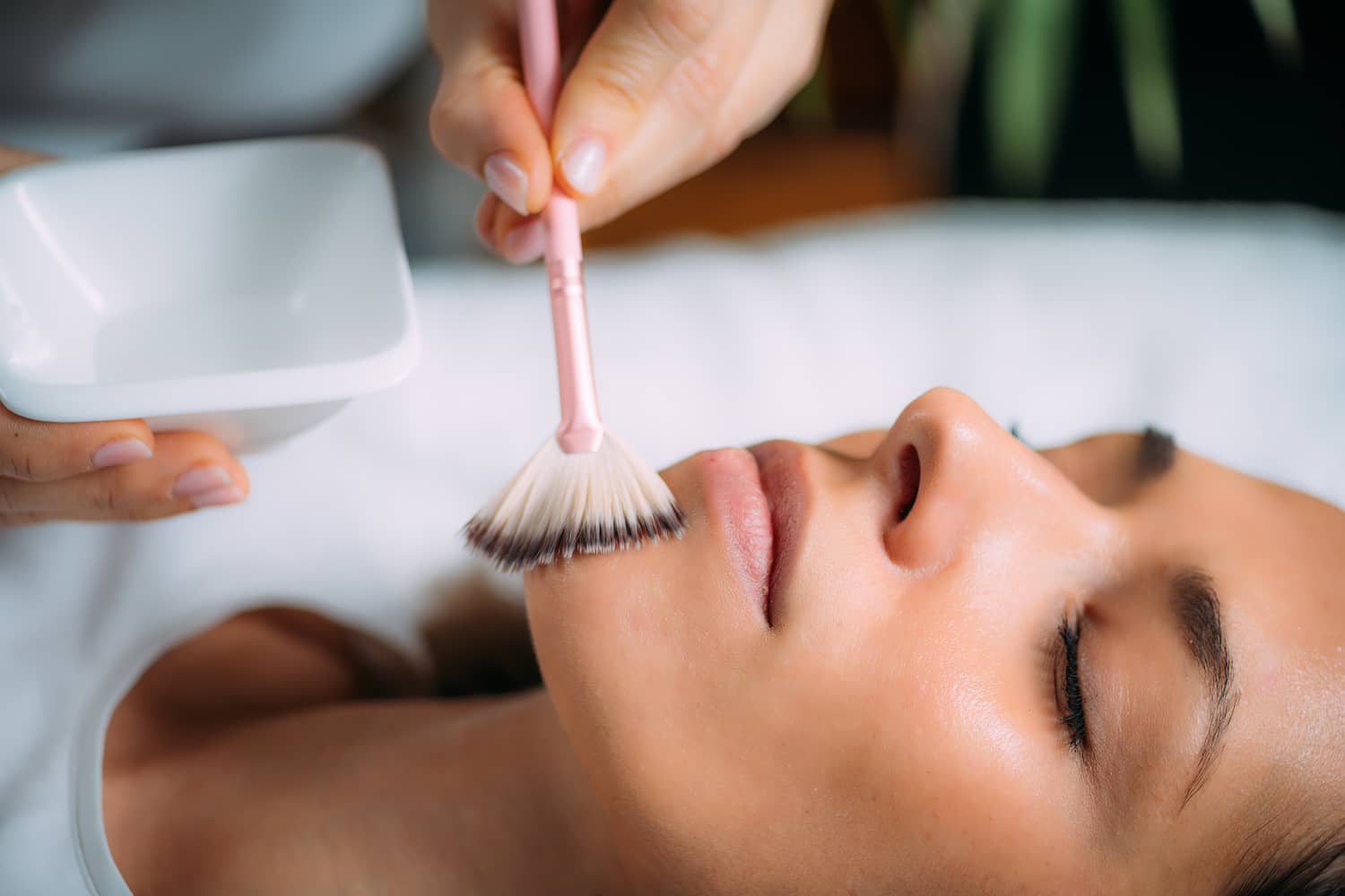 Everything You Need to Know About Chemical Peels for Acne Scars