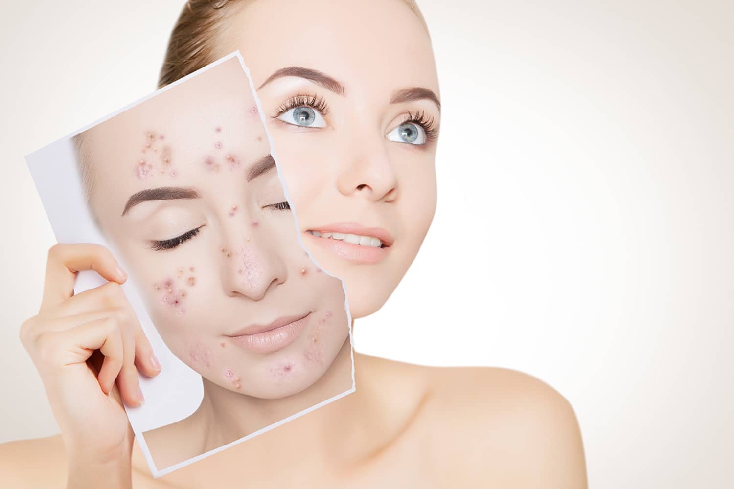 Best Med Spa Treatments For Acne: Chemical Peels and HydroFacials