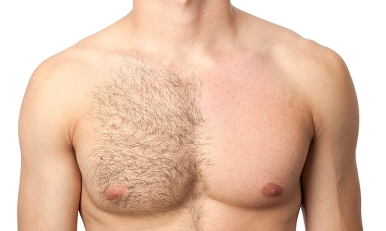 Men's laser hair removal Columbus